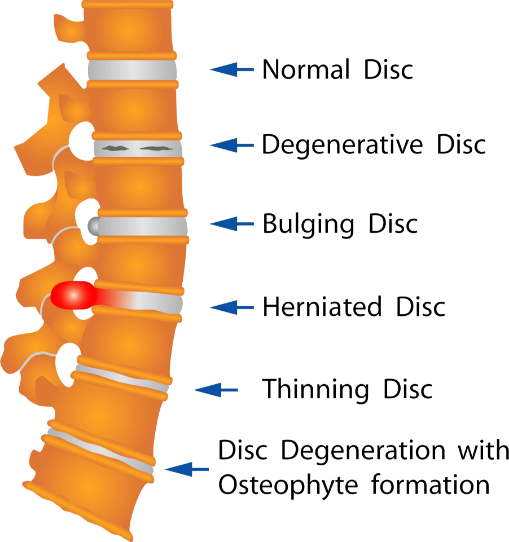 Spinal-decompression